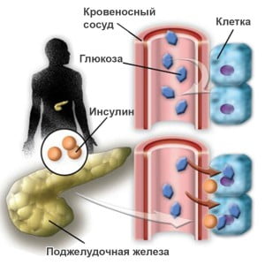 причины сахарного диабета