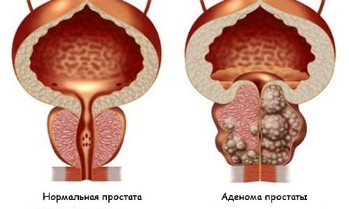 При аденоме простаты мужчин беспокоит боль, т.к. уретральный канал проходит через воспалившуюся предстательную железу