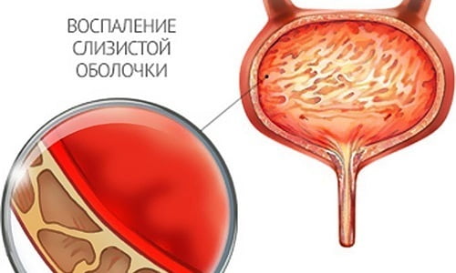 Воспаление мочевого пузыря, или цистит, чаще всего встречается у женщин, но также поражает мужчин и детей
