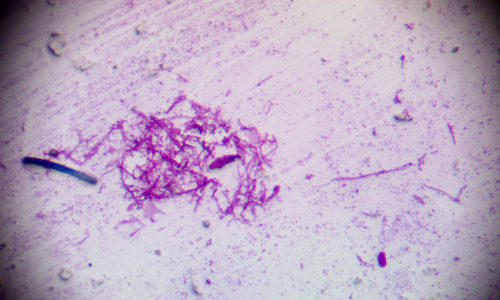 Кандидоз - инфекционное заболевание, вызываемое грибами рода Кандида, относящимися к условно-патогенной микрофлоре