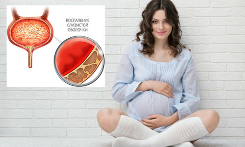 Воспалительный процесс в слизистых оболочках мочевого пузыря нарушает функции выделительной системы, что может негативно сказаться на протекании беременности