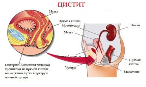 Цистит — это воспаления мочевого пузыря, болезнь распространена среди женщин, но способна поразить мужчин, и детей