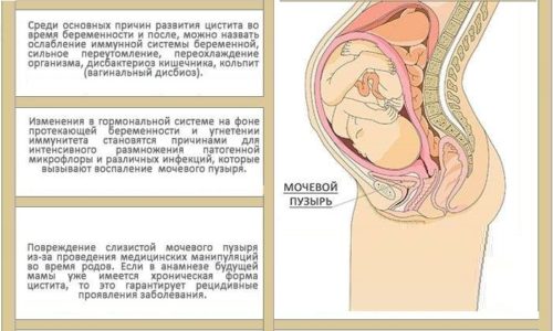 Риски развития цистита повышаются в связи с тем, что увеличивающаяся матка давит на мочевой пузырь