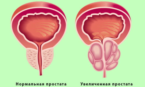 У мужчин острый воспалительный процесс возникает на фоне простатита