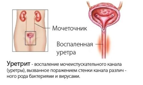 По мере развития уретрита женщина ощущает жжение во время микции. Обнаруживается покраснение гениталий