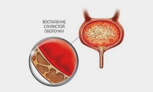 Цистит - воспалительный процесс в слизистых оболочках мочевого пузыря