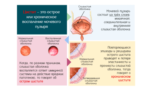 Острый цистит можно устранить быстро, если своевременно начать лечение. Хроническая форма плохо поддается терапии. Лечиться придется несколько лет