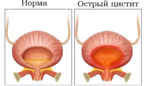 По характеру течения цистит бывает острым