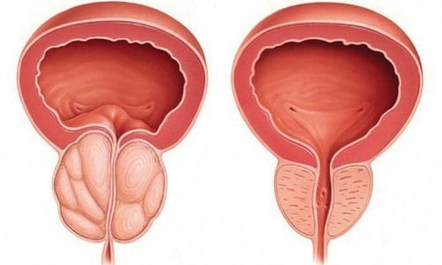 У мужчин посткоитальный цистит развивается на фоне простатита