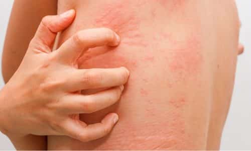 Единственным возможным негативным последствием могут быть аллергические реакции на коже, выраженные в ее покраснении, шелушении и появления раздражений