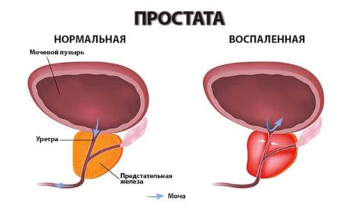У мужчин медикамент используется в лечении простатита бактериального происхождения