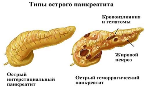 Выделяют патологические состояния, при которых рассматриваемый препарат не назначается. К ним относится: индивидуальная реакция при попадании главного компонента в организм; панкреатит в острой фазе