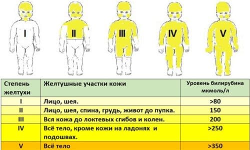 Признак при нарушениях ЖКТ - желтуха