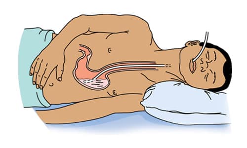 При передозировке терапия предусматривает промывание желудка
