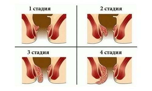 Средство включают в состав комплексного лечения геморроя