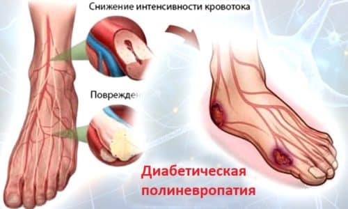 Лекарство назначается для терапии диабетической формы полиневропатии