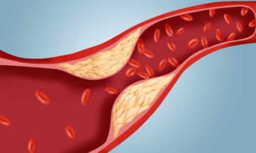 Препарат способен снижать уровень холестерина в крови