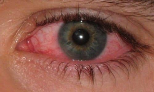 Глазной гель показан в случае сухого кератоконъюнктивита