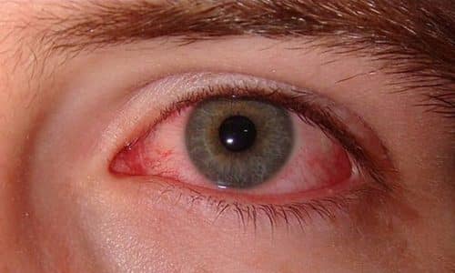 Применение лекарственного средства недопустимо при кровоизлиянии в глазную сетчатку
