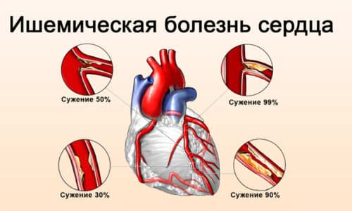Нужно соблюдать осторожность при приеме препарата Лозап 50 во время ишемической болезни сердца