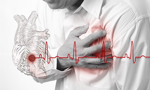 Врачи назначают Лозап 50 для лечения хронической сердечной недостаточности
