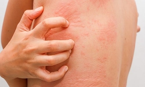Прем рассматриваемого препарата может спровоцировать появление высыпаний на коже