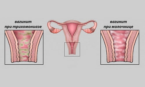 Одно из побочных действий Далацина Ц - вероятность возникновения вагинита