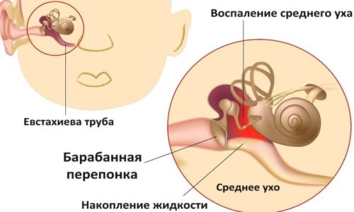 При отите показан Ципролет 250 мг