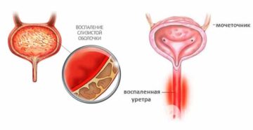 Взаимосвязь цистита и уретрита